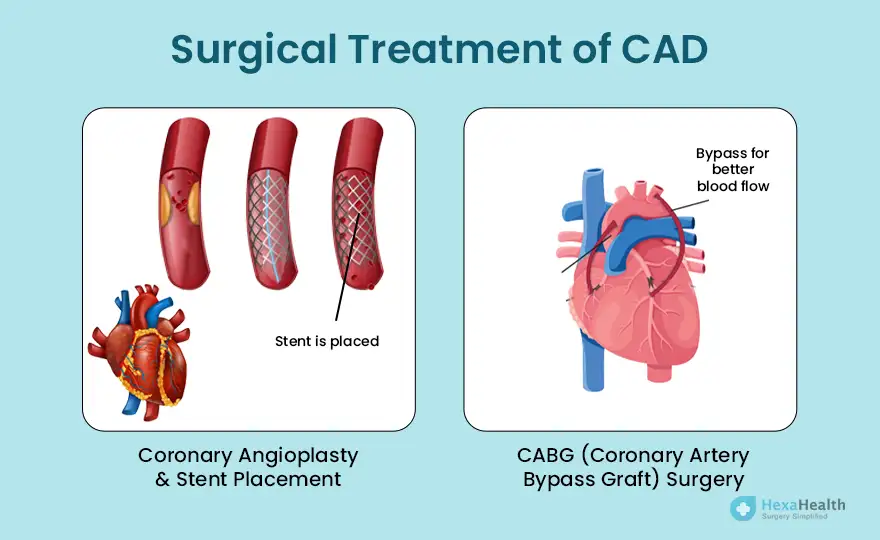 Coronary Artery Disease (CAD)