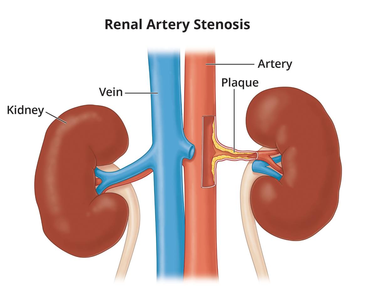 Renal Artery Stenosis