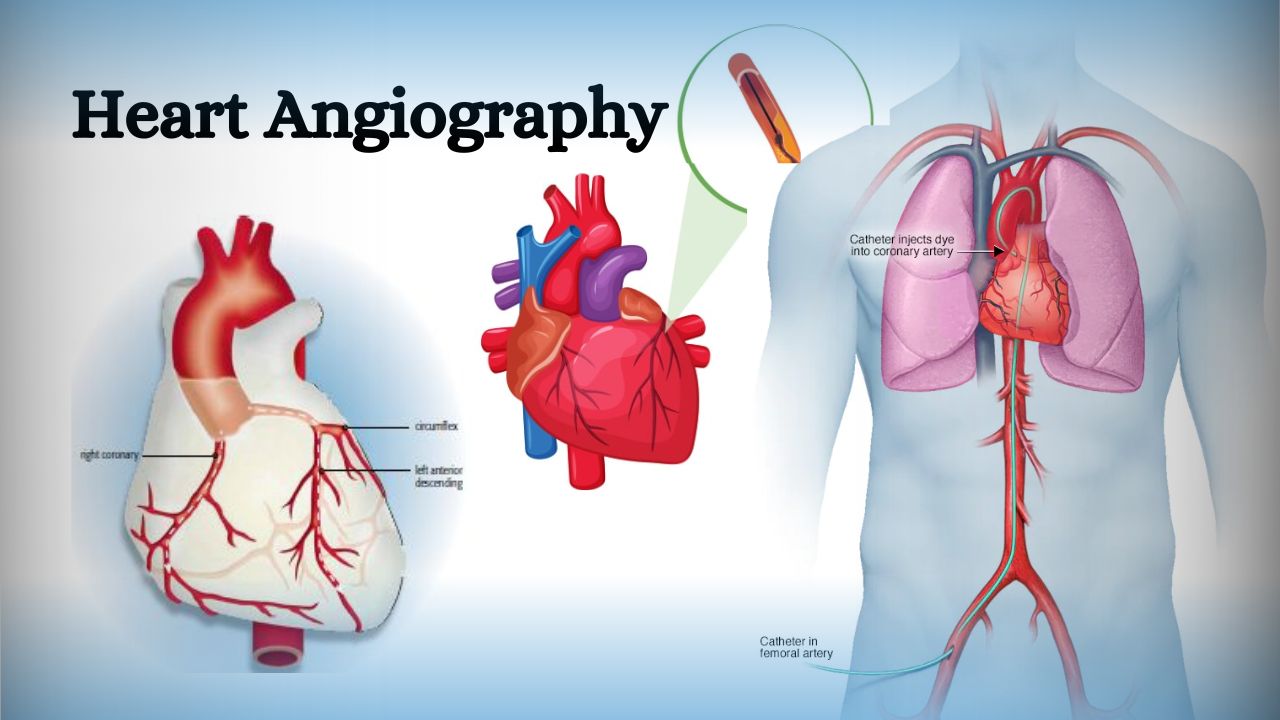 Coronary Artery Disease (CAD)