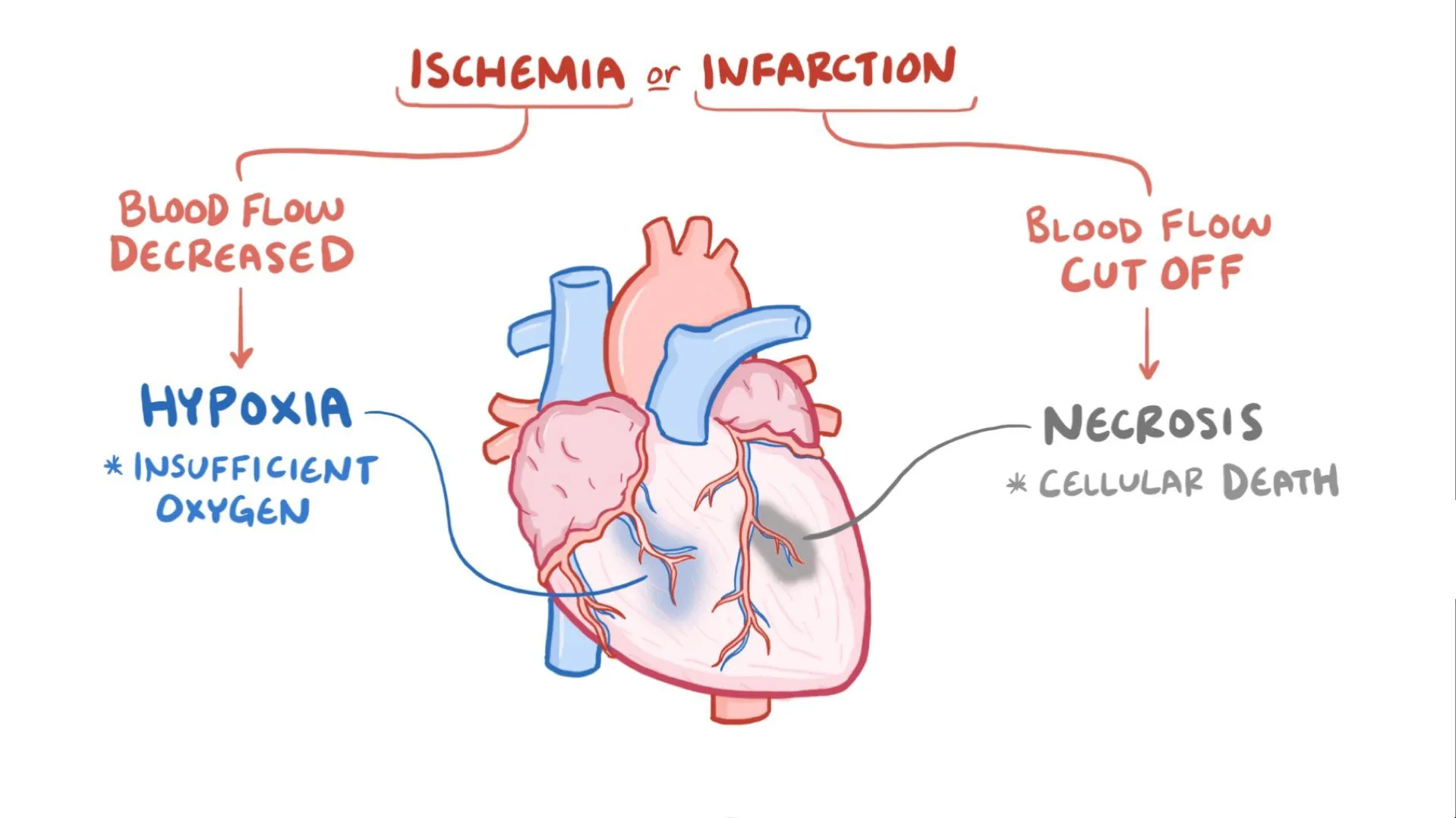 Ischemia (Reduced Blood Flow to Heart)