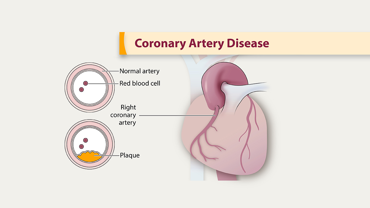 Renal Artery Stenosis