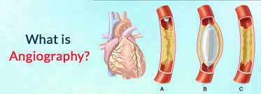 Peripheral Artery Disease (PAD)