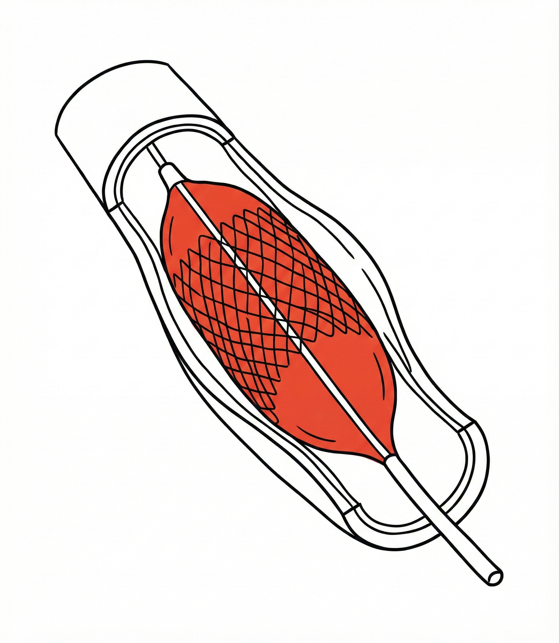 Angioplasty & Stenting