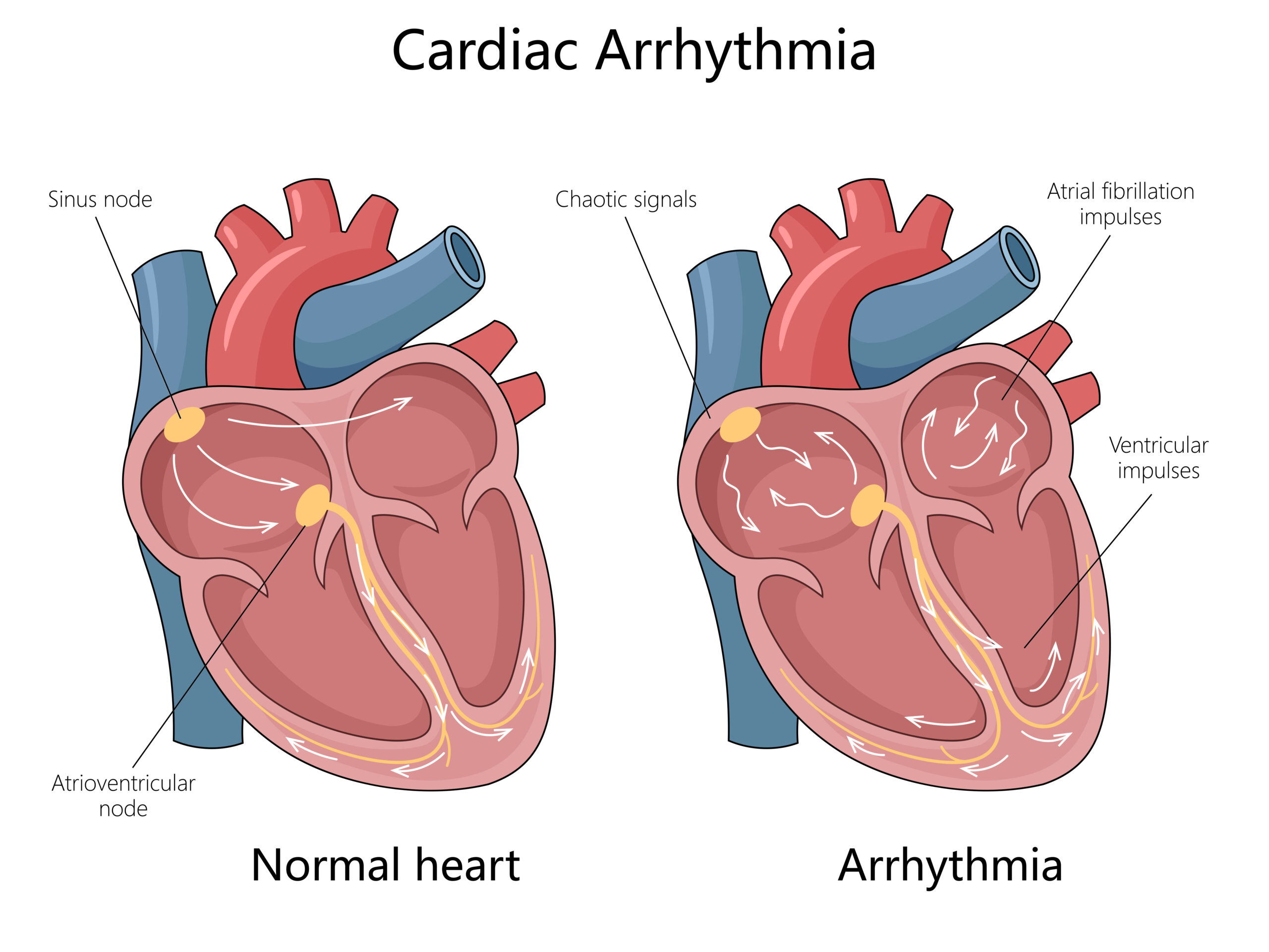 Renal Artery Stenosis