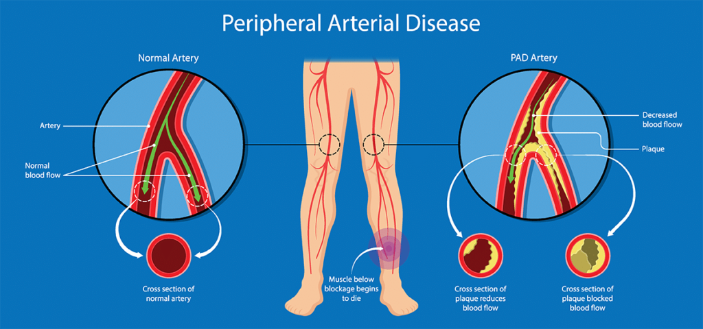 Peripheral Artery Disease (PAD)