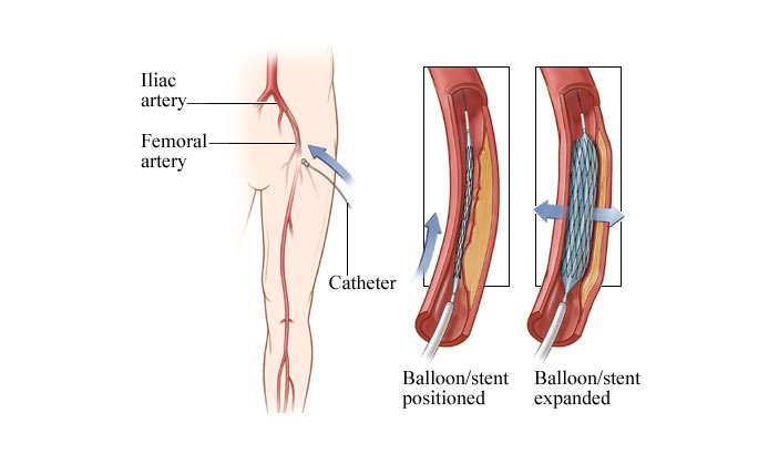 Peripheral Artery Disease (PAD)